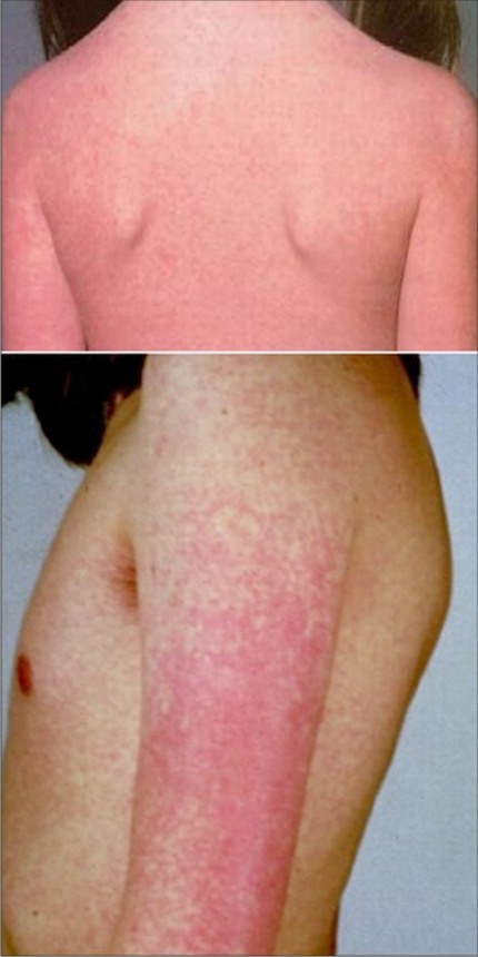 German Measles Signs