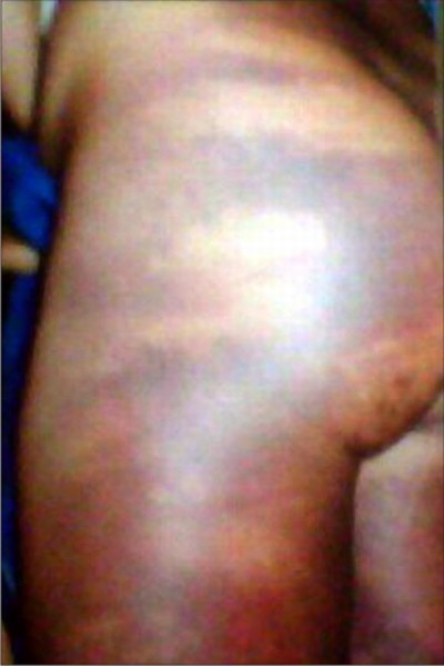 Bruised bottom of the woman