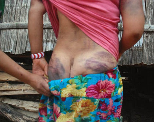 A Villager of Selon showing the marks on her bodies indicating the excesses of AR jawans
