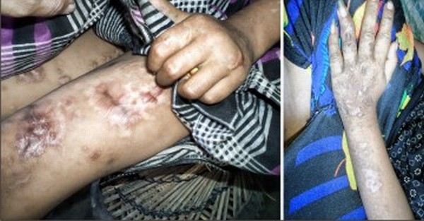 Scars on the limbs of Pangei blast victims