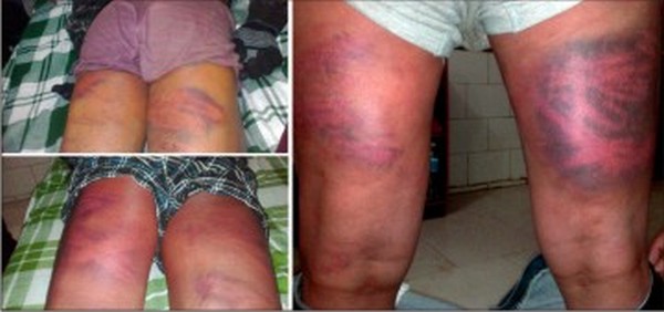The bruises tell the story of the torture the three victims were allegedly subjected to