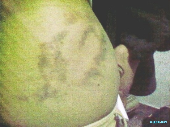 Injury marks of Molested Manipuri Women at Delhi :: 13th Dec 2008