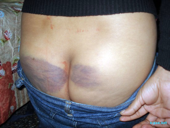 Injury marks of Molested Manipuri Women at Delhi :: 13th Dec 2008