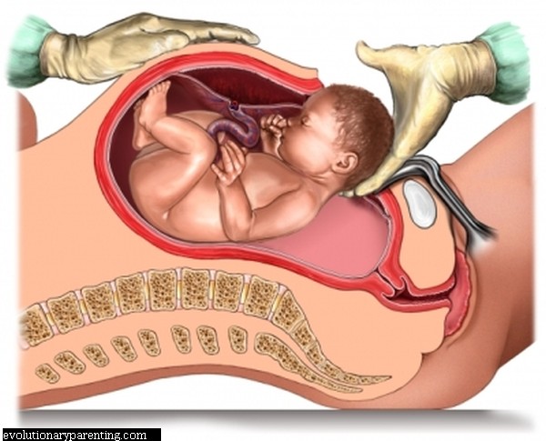 CS (Caesarean Section) and Childbirth